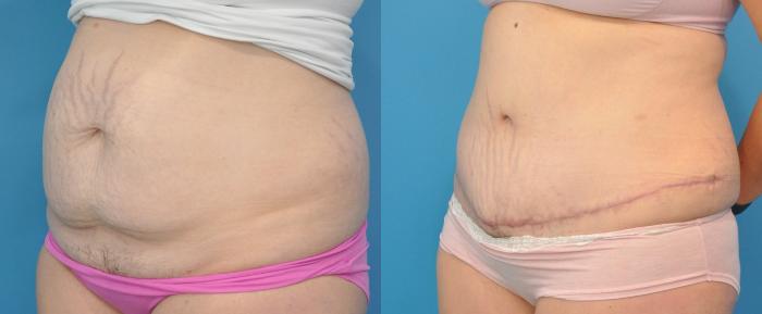Before & After Abdominoplasty/Tummy Tuck Case 105 View #1 View in North Shore, IL