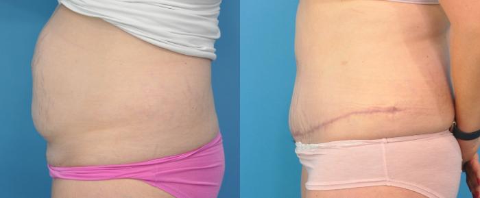 Before & After Abdominoplasty/Tummy Tuck Case 105 View #2 View in North Shore, IL
