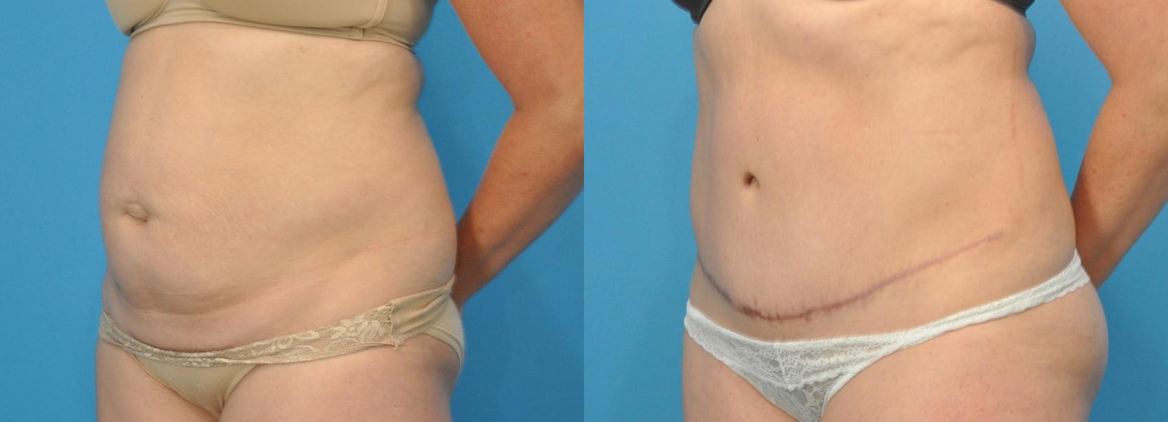 Before & After Abdominoplasty/Tummy Tuck Case 106 View #1 View in Northbrook, IL