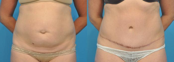 Before & After Abdominoplasty/Tummy Tuck Case 106 View #3 View in Northbrook, IL