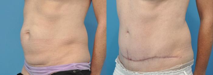 Before & After Abdominoplasty/Tummy Tuck Case 111 View #1 View in North Shore, IL