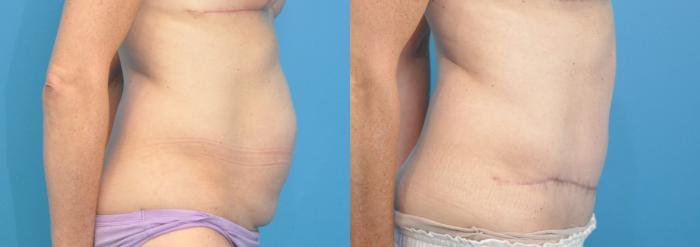 Before & After Abdominoplasty/Tummy Tuck Case 111 View #2 View in North Shore, IL