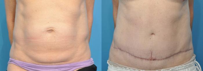 Before & After Abdominoplasty/Tummy Tuck Case 111 View #3 View in North Shore, IL