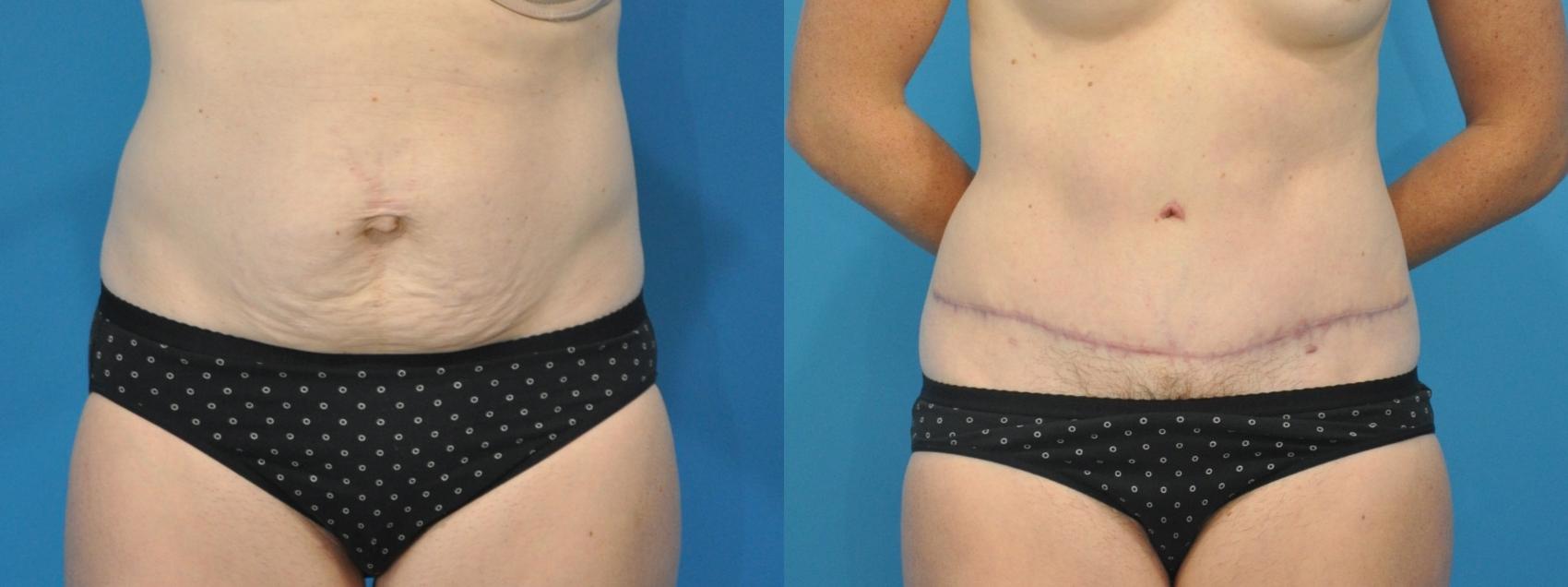 Before & After Abdominoplasty/Tummy Tuck Case 112 View #1 View in North Shore, IL