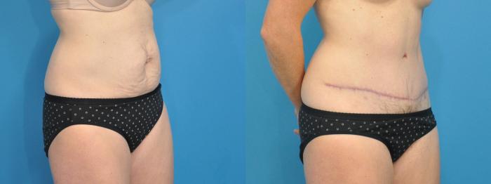 Before & After Abdominoplasty/Tummy Tuck Case 112 View #2 View in North Shore, IL