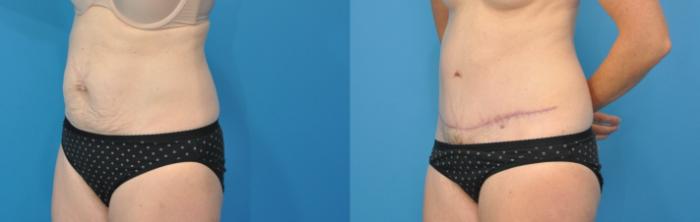 Before & After Abdominoplasty/Tummy Tuck Case 112 View #5 View in North Shore, IL
