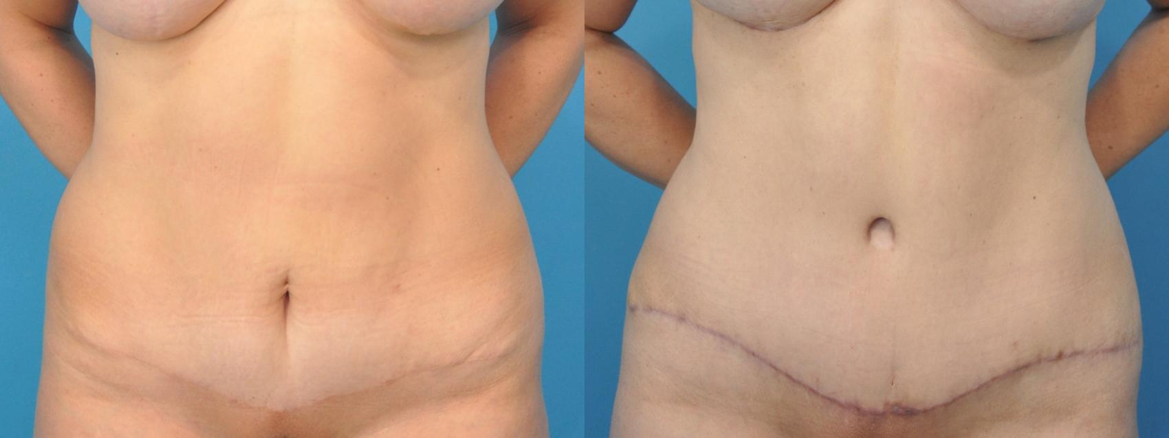 Before & After Abdominoplasty/Tummy Tuck Case 125 View #1 View in North Shore, IL