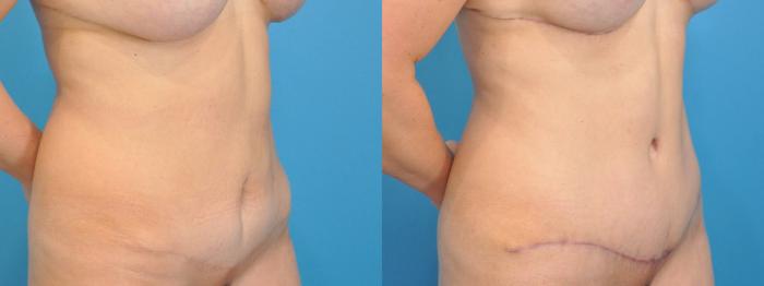 Before & After Abdominoplasty/Tummy Tuck Case 125 View #2 View in North Shore, IL