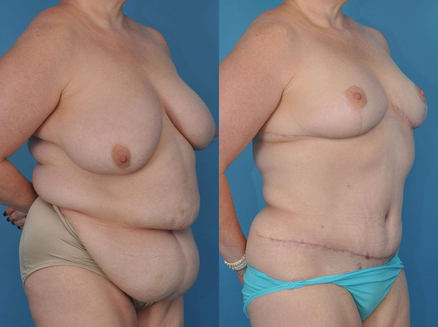Before & After Abdominoplasty/Tummy Tuck Case 13 View #1 View in Northbrook, IL