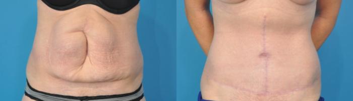 Before & After Abdominoplasty/Tummy Tuck Case 136 View #1 View in North Shore, IL