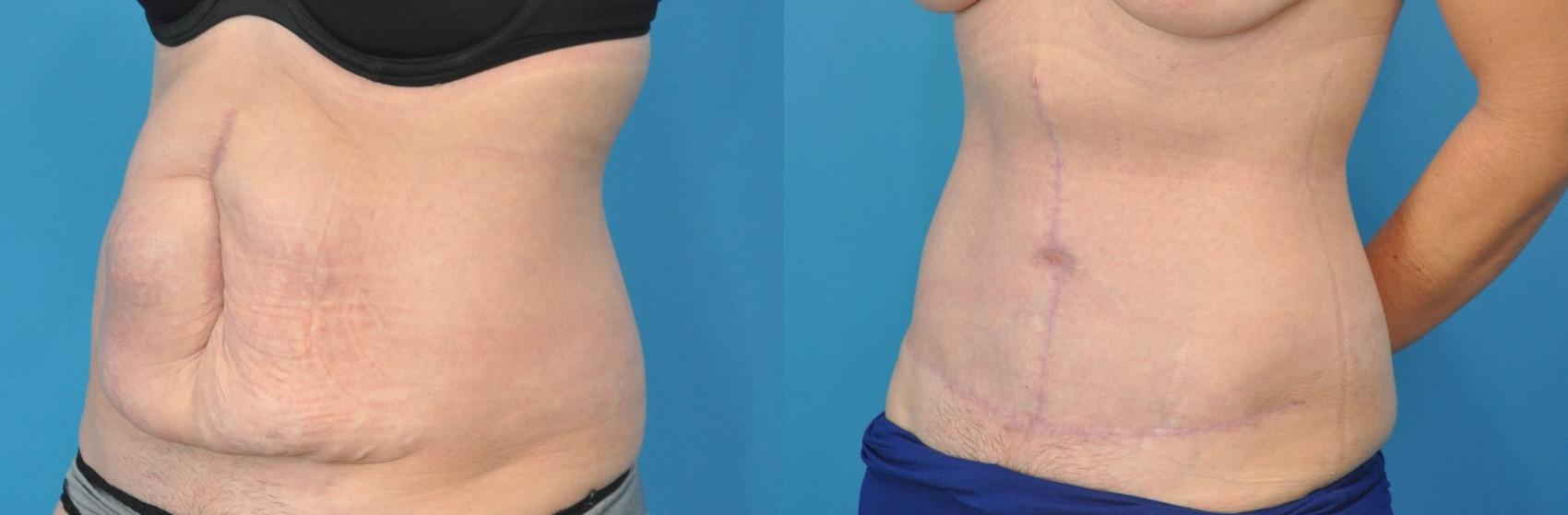 Before & After Abdominoplasty/Tummy Tuck Case 136 View #3 View in Northbrook, IL