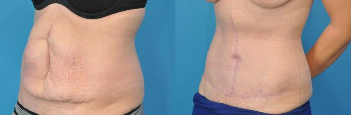 Before & After Abdominoplasty/Tummy Tuck Case 136 View #3 View in North Shore, IL