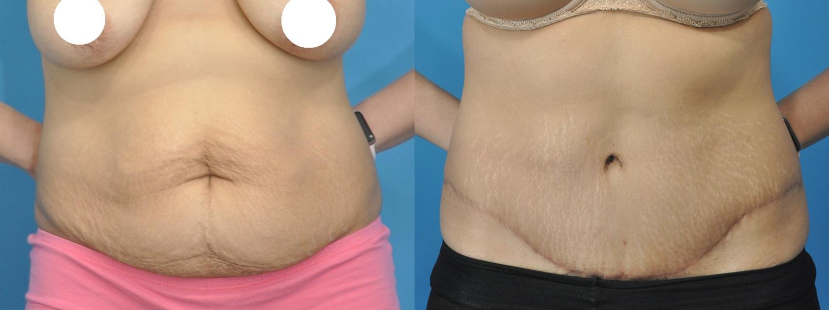Before & After Abdominoplasty/Tummy Tuck Case 146 View #1 View in Northbrook, IL