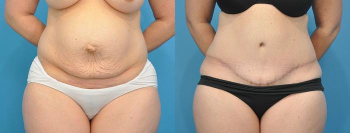 Before & After Abdominoplasty/Tummy Tuck Case 156 View #1 View in Northbrook, IL