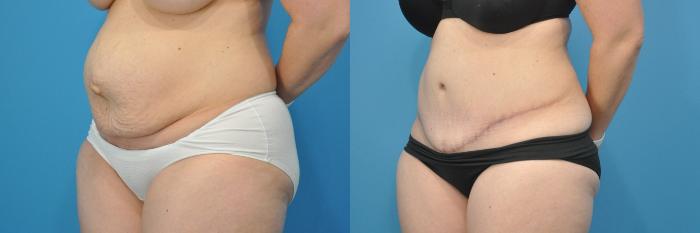 Before & After Abdominoplasty/Tummy Tuck Case 156 View #2 View in North Shore, IL