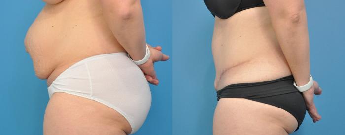 Before & After Abdominoplasty/Tummy Tuck Case 156 View #3 View in North Shore, IL