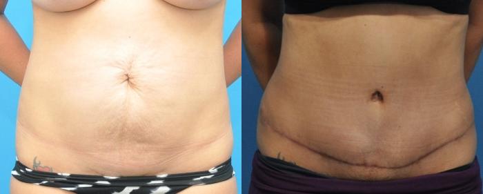 Before & After Abdominoplasty/Tummy Tuck Case 159 View #1 View in Northbrook, IL