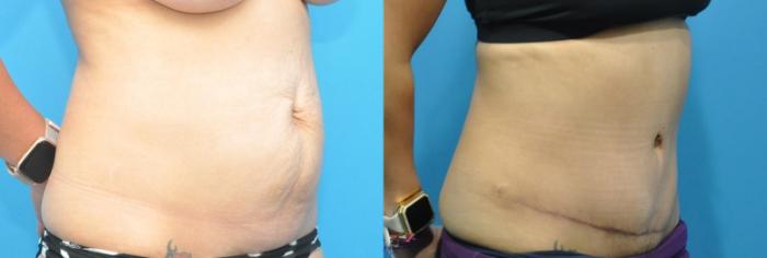 Before & After Abdominoplasty/Tummy Tuck Case 159 View #2 View in North Shore, IL