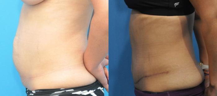 Before & After Abdominoplasty/Tummy Tuck Case 159 View #3 View in North Shore, IL