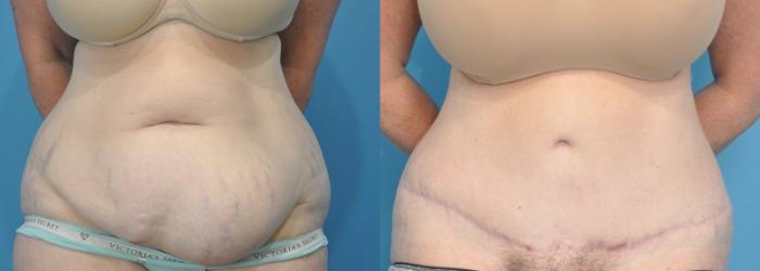 Before & After Abdominoplasty/Tummy Tuck Case 170 View #1 View in Northbrook, IL