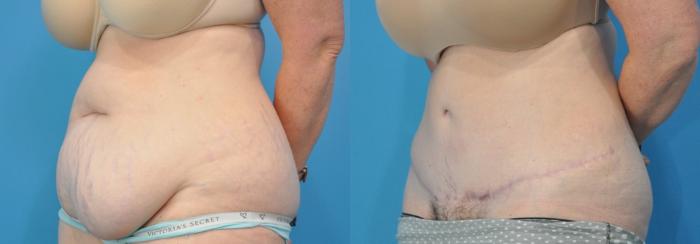 Before & After Abdominoplasty/Tummy Tuck Case 170 View #2 View in Northbrook, IL
