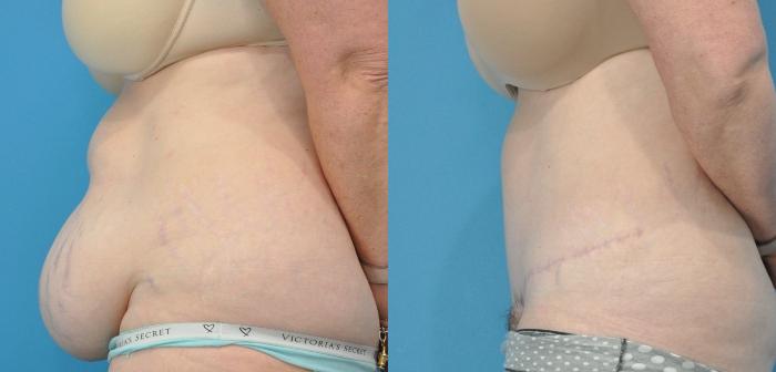 Before & After Abdominoplasty/Tummy Tuck Case 170 View #3 View in Northbrook, IL