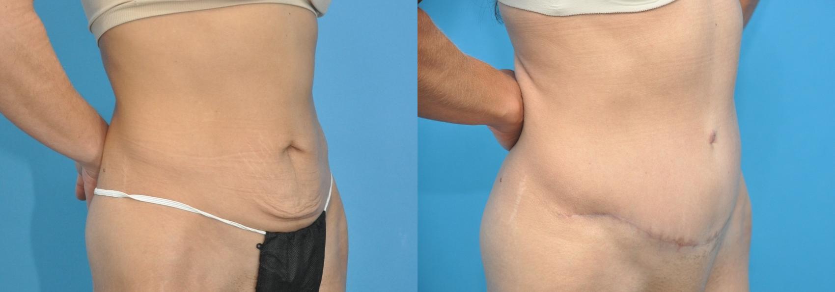 Before & After Abdominoplasty/Tummy Tuck Case 176 View #1 View in Northbrook, IL