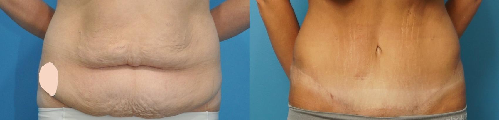 Before & After Abdominoplasty/Tummy Tuck Case 182 View #1 View in North Shore, IL