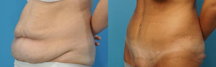Before & After Abdominoplasty/Tummy Tuck Case 182 View #2 View in North Shore, IL