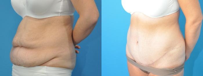 Before & After Abdominoplasty/Tummy Tuck Case 182 View #3 View in North Shore, IL