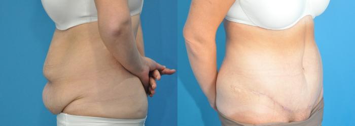 Before & After Abdominoplasty/Tummy Tuck Case 182 View #4 View in North Shore, IL