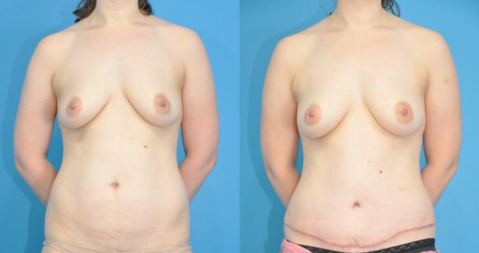 Before & After Abdominoplasty/Tummy Tuck Case 187 View #1 View in North Shore, IL