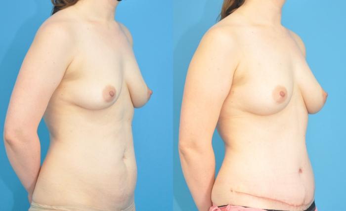 Before & After Abdominoplasty/Tummy Tuck Case 187 View #2 View in North Shore, IL