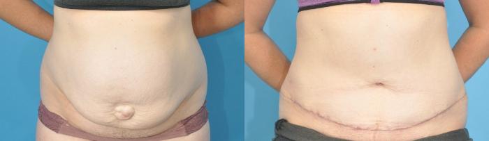 Before & After Abdominoplasty/Tummy Tuck Case 189 View #1 View in Northbrook, IL