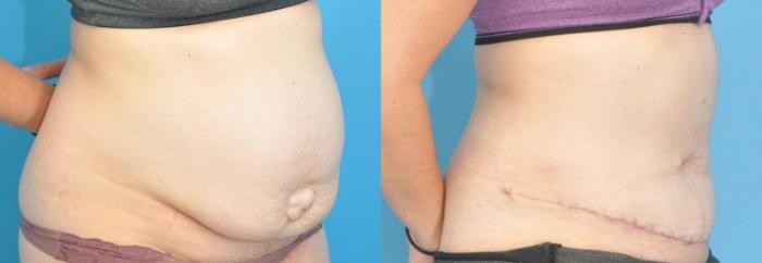 Before & After Abdominoplasty/Tummy Tuck Case 189 View #2 View in Northbrook, IL