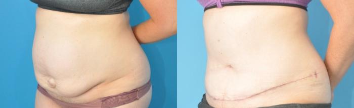 Before & After Abdominoplasty/Tummy Tuck Case 189 View #3 View in Northbrook, IL