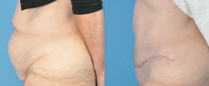Before & After Abdominoplasty/Tummy Tuck Case 190 View #1 View in North Shore, IL