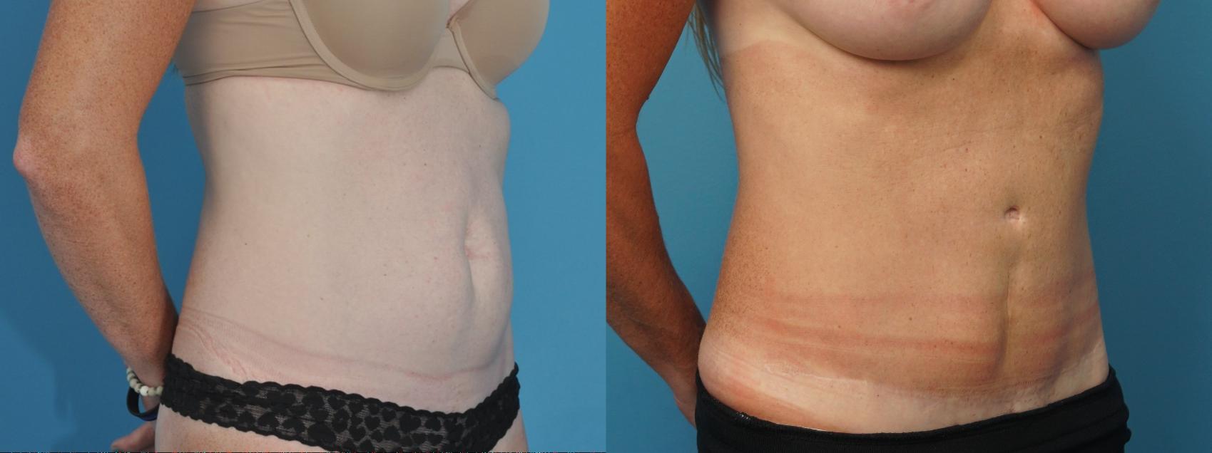 Before & After Abdominoplasty/Tummy Tuck Case 192 View #1 View in North Shore, IL