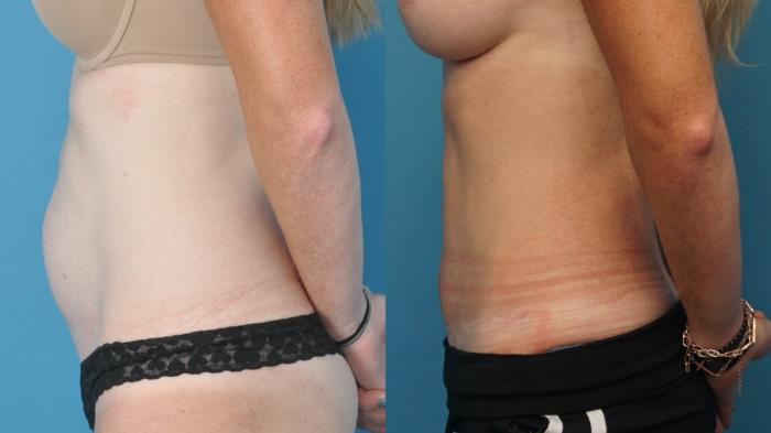 Before & After Abdominoplasty/Tummy Tuck Case 192 View #2 View in North Shore, IL