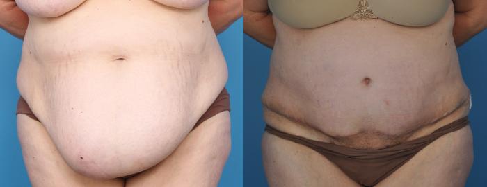 Before & After Abdominoplasty/Tummy Tuck Case 20 View #1 View in Northbrook, IL
