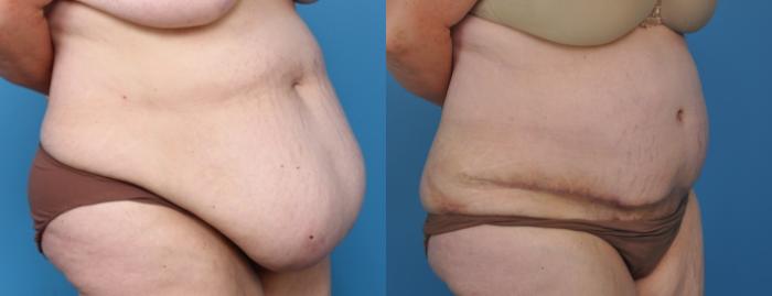 Before & After Abdominoplasty/Tummy Tuck Case 20 View #2 View in Northbrook, IL