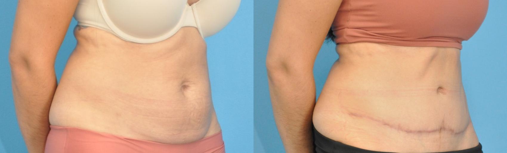 Before & After Abdominoplasty/Tummy Tuck Case 200 View #1 View in North Shore, IL