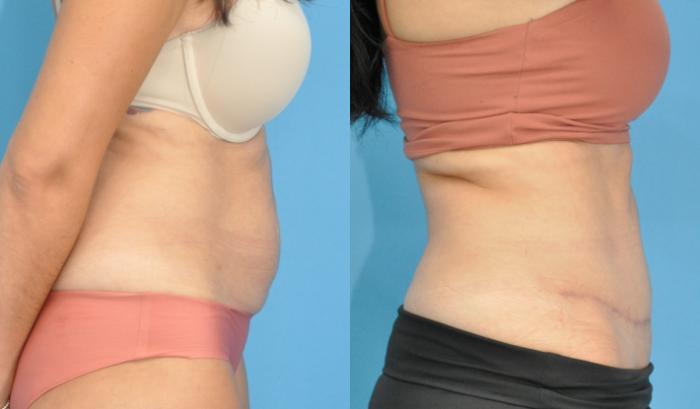Before & After Abdominoplasty/Tummy Tuck Case 200 View #2 View in North Shore, IL