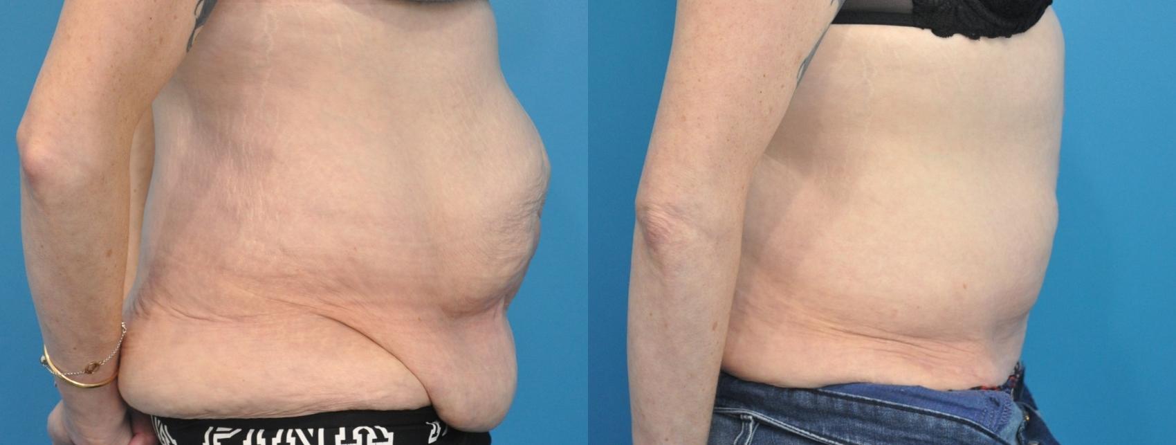 Before & After Abdominoplasty/Tummy Tuck Case 209 View #1 View in North Shore, IL