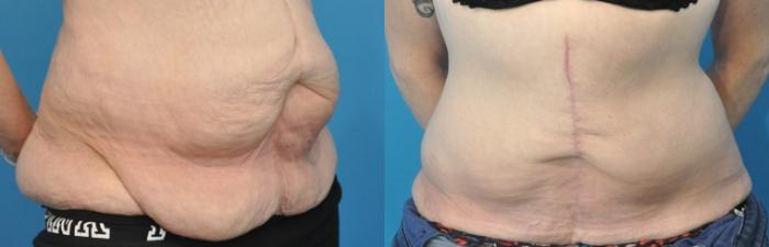 Before & After Abdominoplasty/Tummy Tuck Case 209 View #2 View in North Shore, IL