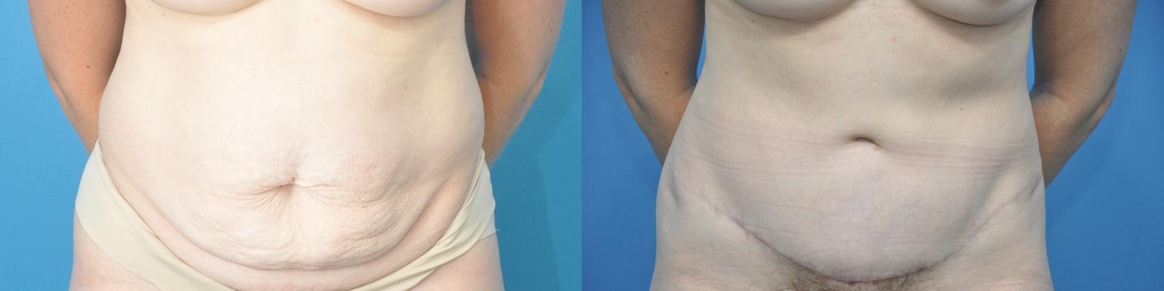 Before & After Abdominoplasty/Tummy Tuck Case 217 View #1 View in North Shore, IL