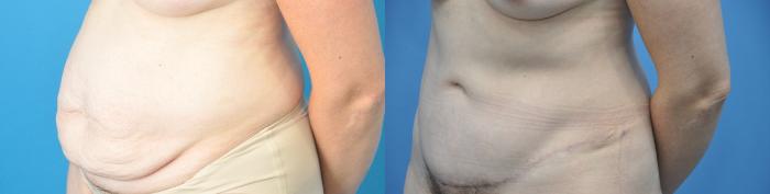 Before & After Abdominoplasty/Tummy Tuck Case 217 View #2 View in North Shore, IL