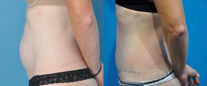 Before & After Abdominoplasty/Tummy Tuck Case 219 View #1 View in Northbrook, IL