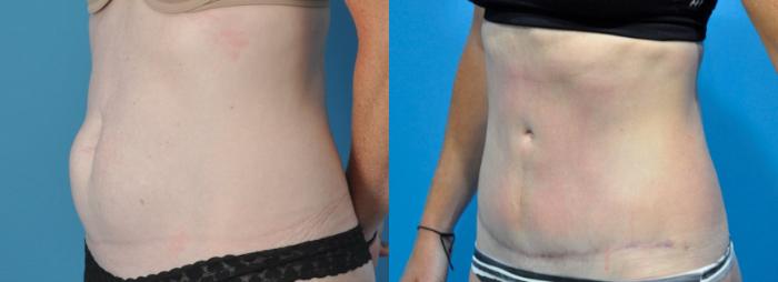 Before & After Abdominoplasty/Tummy Tuck Case 219 View #2 View in Northbrook, IL