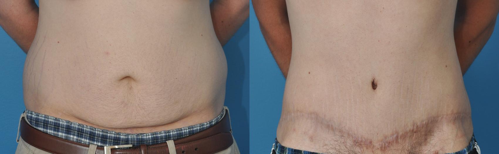Before & After Abdominoplasty/Tummy Tuck Case 22 View #1 View in North Shore, IL